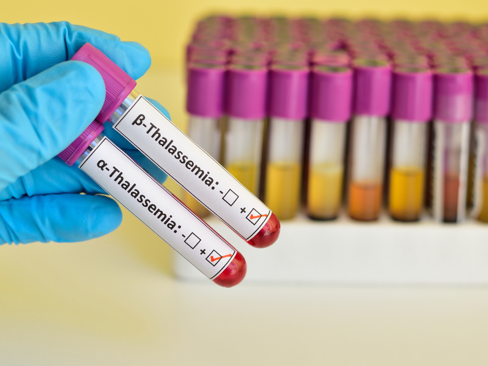 Thalassaemia Screening Program
